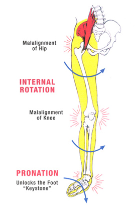 Overpronation